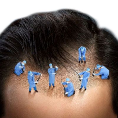 HAIR TRANSPLANTATION